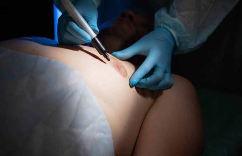 Cirurgia de Ginecomastia Bilateral Masculina Marcar Tambaú - Cirurgia Ginecomastia