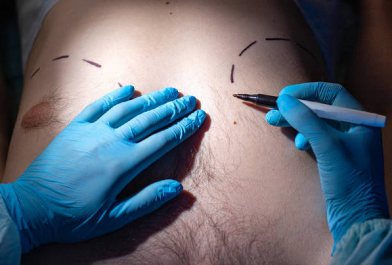 Cirurgia de Ginecomastia Neonatal Marcar Ribeira - Cirurgia de Ginecomastia Masculina