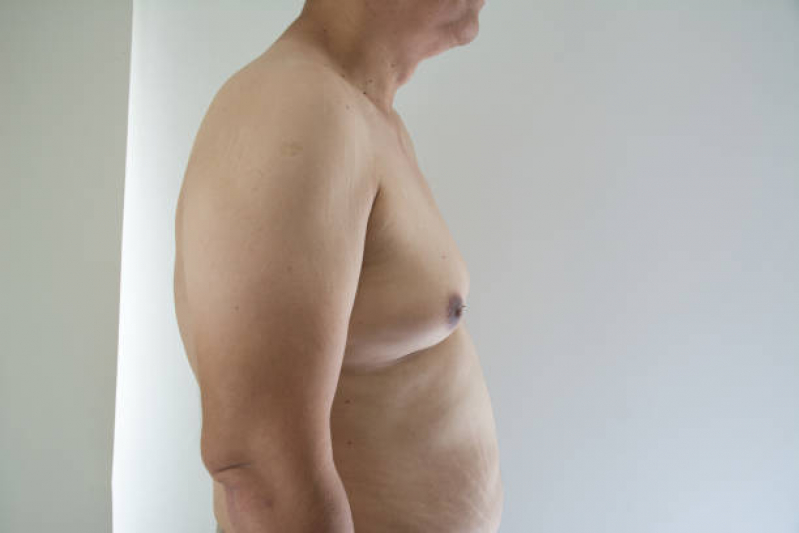 Cirurgia de Ginecomastia para Homens Marcar Itatiba - Cirurgia de Ginecomastia Neonatal