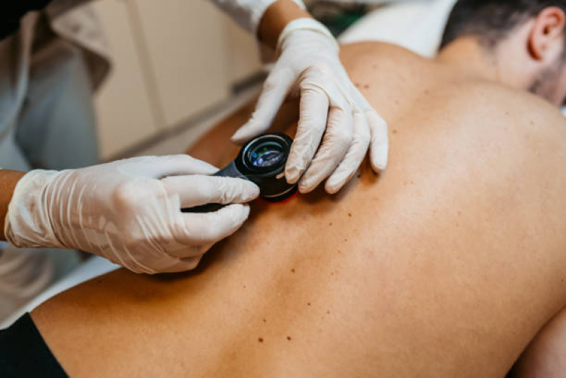 Onde Fazer Tratamento para Remoção de Cicatrizes Diadema - Tratamento para Câncer de Pele