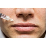 Aplicação de Toxina Botulínica nos Lábios