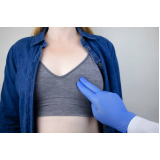 cirurgia de ginecomastia feminina marcar Analândia