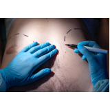 cirurgia de ginecomastia neonatal marcar Victório Area Sante