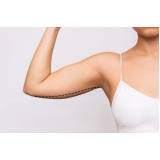 cirurgia de remoção de pele dos braços clínica Guararema