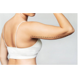 cirurgia de remoção de pele dos braços Parque Planalto