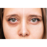 clínica especialista em preenchimento olheira Conchal