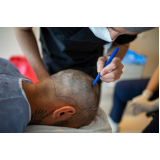 clínica especializada em transplante de cabelo para diminuir a testa Santa Maria Da Serra