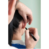 onde fazer cirurgia para harmonização das orelhas Victório Area Sante