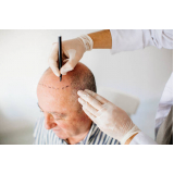 transplante de cabelo de homem marcar Victório Area Sante