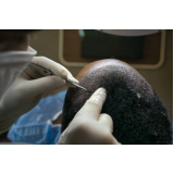 transplante de cabelo para diminuir a testa Nova Europa